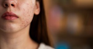 Intestino e Pele: Explicação Eczema, Acne e Outros Sintomas